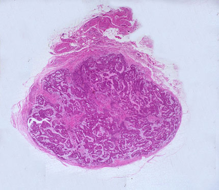 顕微鏡で見た腫瘍細胞